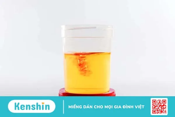 Đi tiểu ra máu ở nữ cảnh báo bệnh lý gì?