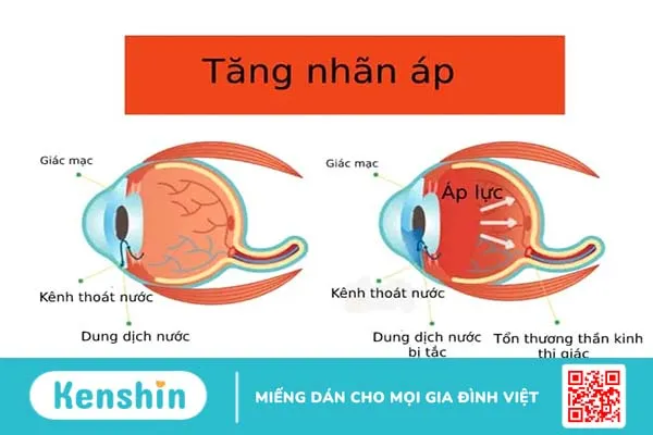 Đi tìm cơ hội chữa khỏi cho bệnh tăng nhãn áp