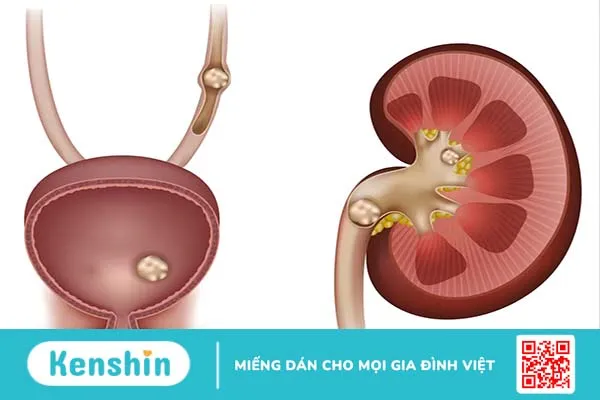 Đi tìm lời giải đáp: Sỏi thận kiêng ăn gì để nhanh khỏi bệnh?