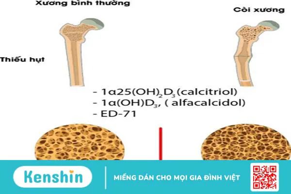 Đi tìm nguyên nhân của bệnh loãng xương ở người già và cách phòng ngừa