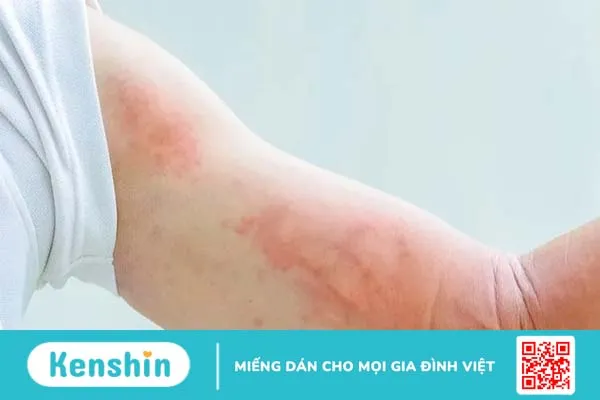 Dị ứng hóa chất: Cẩn thận với sản phẩm bạn hay sử dụng