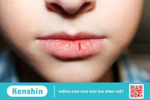 Dị ứng son môi: Những điều phái đẹp nhất định phải biết!