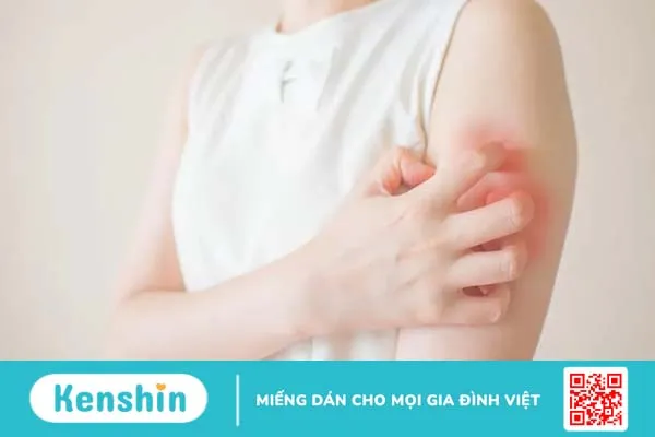 Dị ứng tôm : Cách xử lý và phòng ngừa hiệu quả