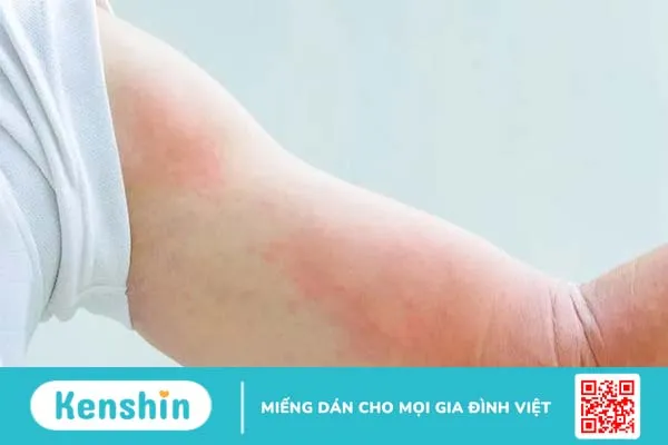 Dị ứng với động vật và côn trùng: Những điều bạn cần biết