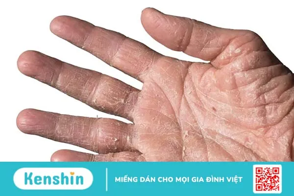 Dị ứng xi măng có nguy hiểm không, điều trị như thế nào?