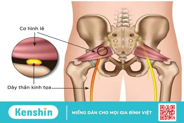 “Điểm mặt” 8 nguyên nhân gây bệnh đau lưng chủ yếu ở phụ nữ