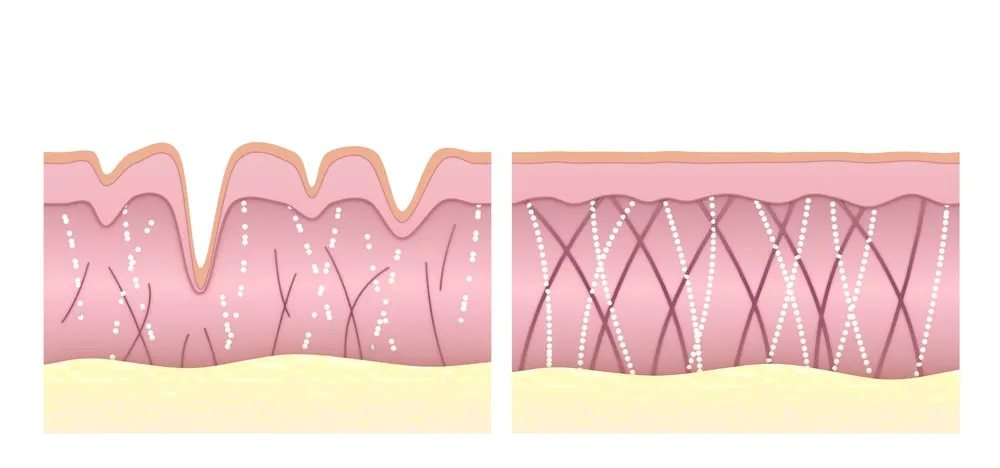 Điện di collagen có tốt không? Có tác dụng gì cho da