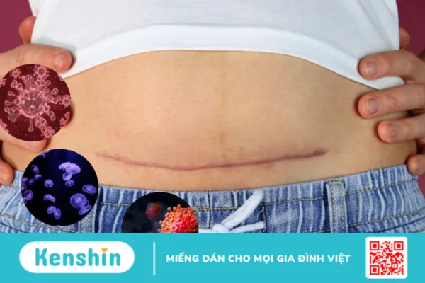 Điều cần biết về nhiễm trùng sau sinh mổ (phần 1)