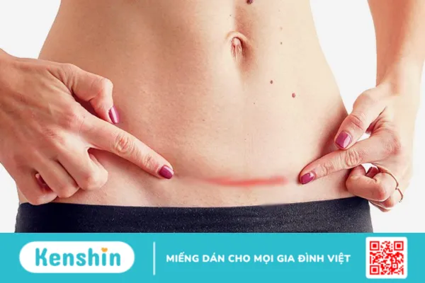 Điều cần biết về nhiễm trùng sau sinh mổ (phần 1)