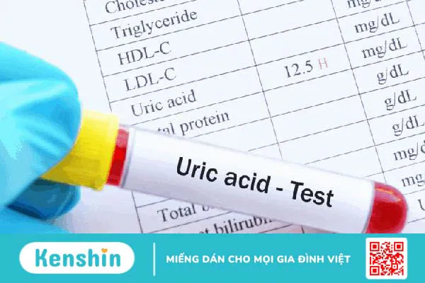 Điều trị bệnh gout bằng những phương pháp nào?