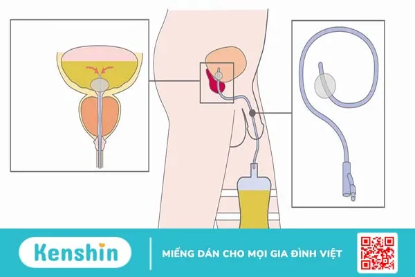 Điều trị bệnh thận ứ nước: Thoát nước tiểu là ưu tiên hàng đầu