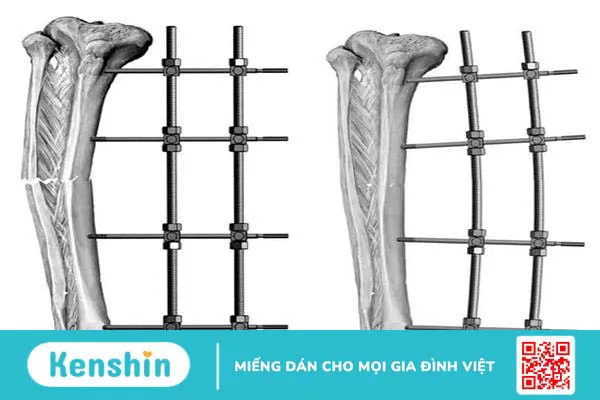 Điều trị gãy xương: Bảo tồn hay phẫu thuật?