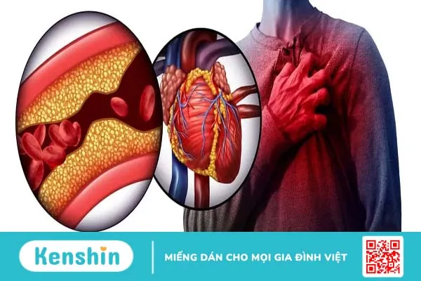 Điều trị nhồi máu cơ tim: Những điều bạn cần biết