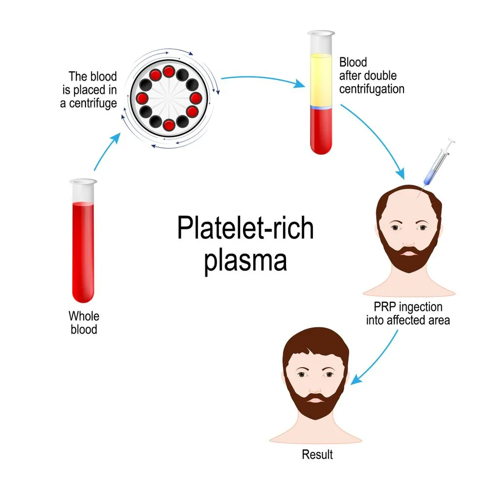 Điều trị rụng tóc bằng phương pháp PRP