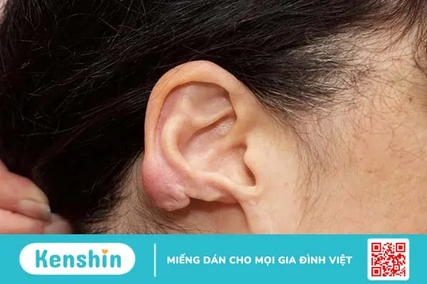 Điều trị sẹo lồi ở tai sau khi bắn lỗ tai