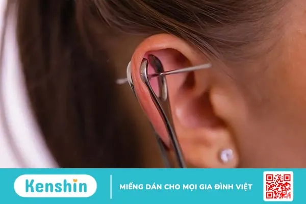 Điều trị sẹo lồi ở tai sau khi bắn lỗ tai