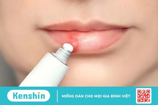 Điều trị sẹo ở môi do Herpes, mụn rộp môi, mụn nước: Cần làm thế nào?