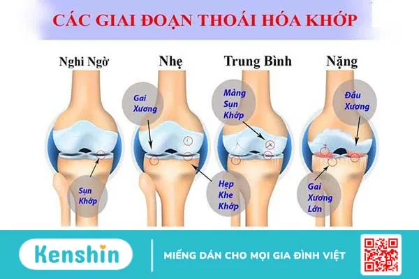 Điều trị thoái hóa khớp gối: Ăn gì và kiêng gì?