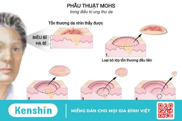 Điều trị ung thư da: Phương pháp nào phù hợp với bạn?