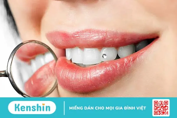 Đính đá lên răng thẩm mỹ là gì? Quy trình gắn đá lên răng và những lưu ý