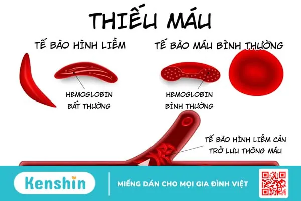 Dinh dưỡng cho người ghép thận và những điều bạn cần biết