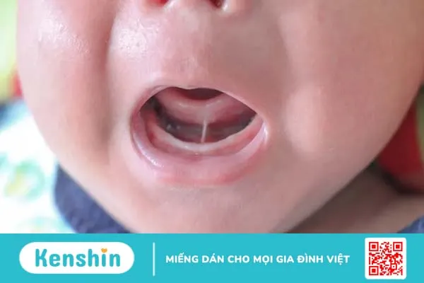 Dính thắng lưỡi ở trẻ em: Nguyên nhân, triệu chứng và cách xử lý