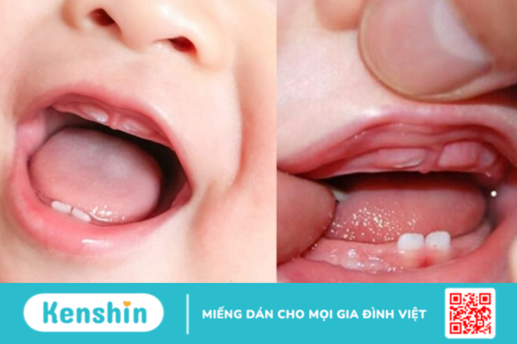 Dính thắng môi ở trẻ: Làm sao để nhận biết và điều trị?