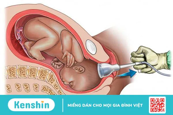 Đỡ đẻ bằng giác hút có thể gây ra những rủi ro nào cho bé khi sinh?