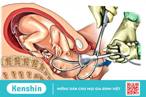 Đỡ đẻ bằng kẹp forceps liệu có thể gây hại cho thai nhi?