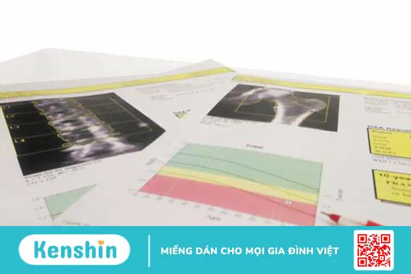 Đo mật độ xương (BMD) là gì ?