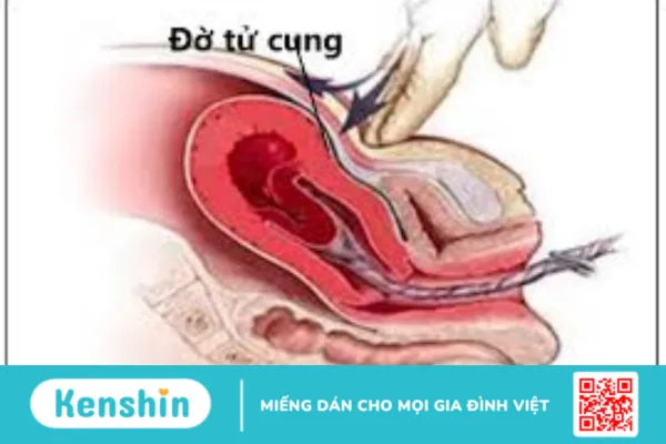 Đờ tử cung sau sinh: Mẹ đã hiểu rõ biến chứng nguy hiểm này?