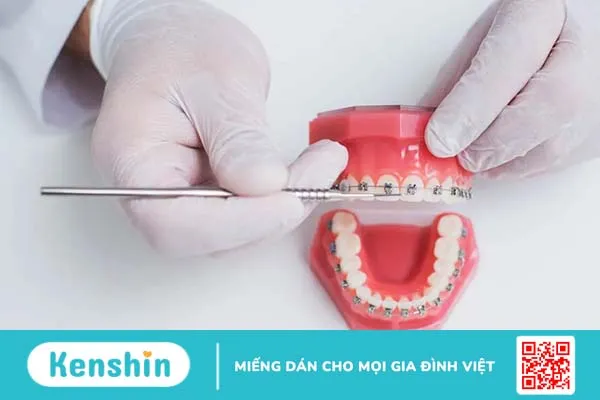 Độ tuổi niềng răng lý tưởng là khi nào? Vì sao không nên trì hoãn?