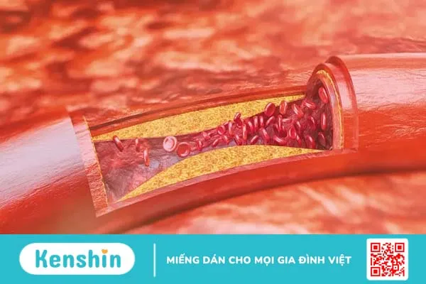 Động mạch ngoại biên (PAD)