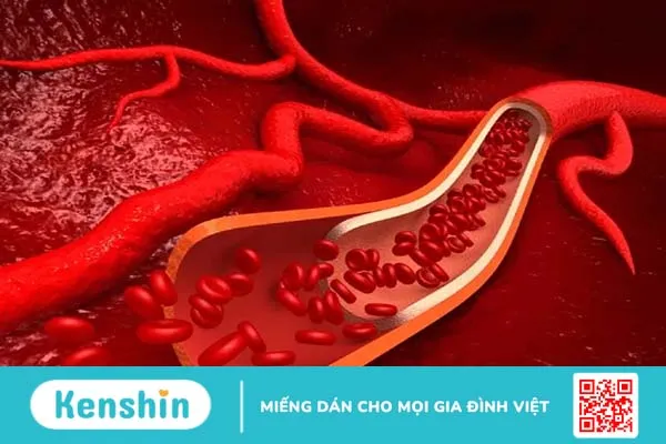 Động mạch ngoại biên (PAD)