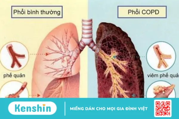 Đợt cấp COPD: Làm sao để phòng ngừa và điều trị hiệu quả?