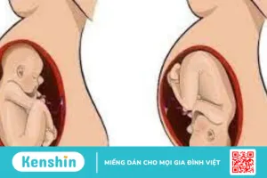 Đưa bé vào ngôi thai thuận trước sinh giúp mẹ sinh con dễ dàng