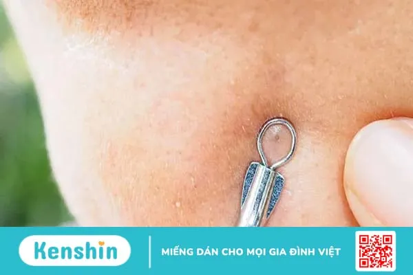 Dụng cụ nặn mụn và cách nặn mụn an toàn tại nhà