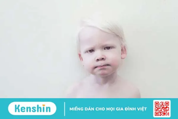 Đừng nhầm lẫn giữa bạch tạng và bạch biến