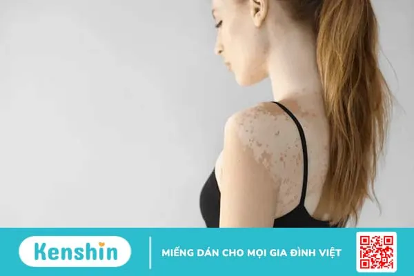 Đừng nhầm lẫn giữa bạch tạng và bạch biến