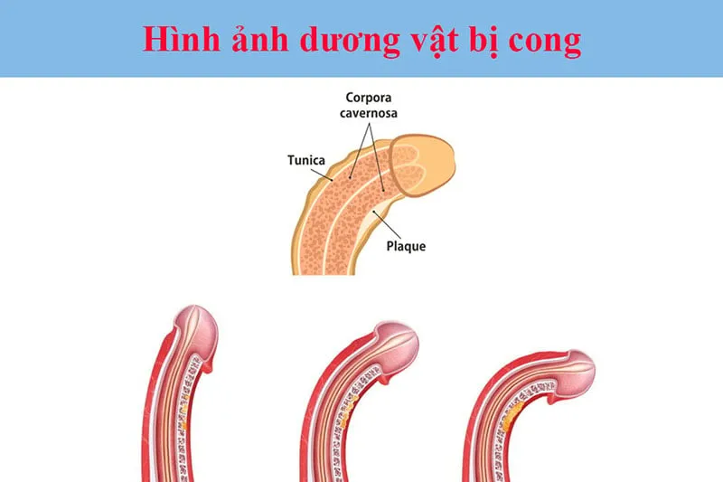 Dương vật bị lệch sang trái có nguy hiểm không?