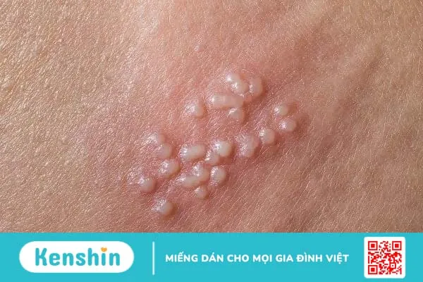 Dương vật bị ngứa do nguyên nhân gì? Làm thế nào để giảm khó chịu?