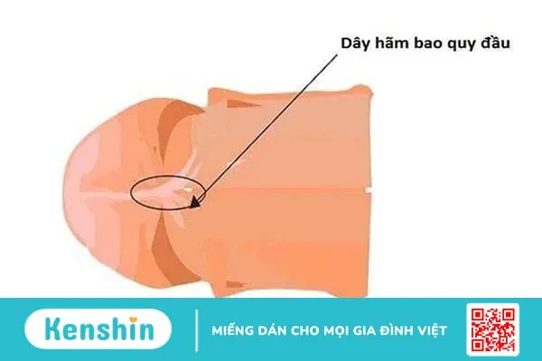 Đứt dây hãm bao quy đầu: Nguyên nhân, triệu chứng và cách điều trị