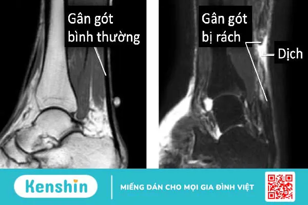 Đứt gân gót chân (gân Achilles)