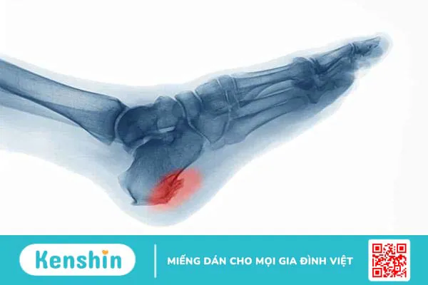 Gai xương: Nguyên nhân, triệu chứng và cách điều trị