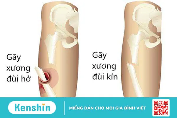 Gãy xương đùi