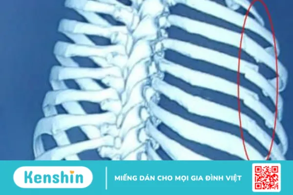 Gãy xương sườn điều trị thế nào ?