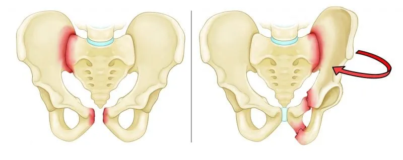 Gãy xương vùng chậu