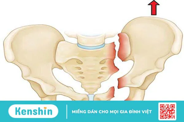 Gãy xương vùng chậu