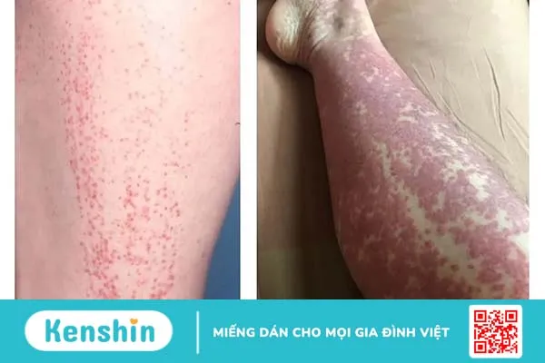 Giả đáp: Viêm mao mạch dị ứng có chữa được không?