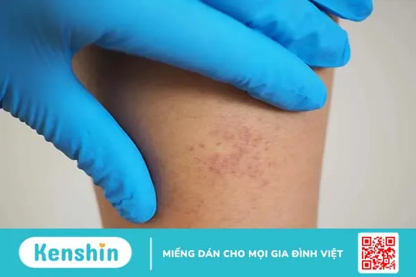 Giả đáp: Viêm mao mạch dị ứng có chữa được không?